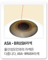 ASA라섹