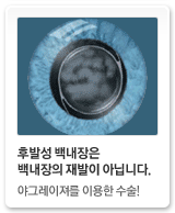 후발성 백내장은 백내장의 재발이 아닙니다.