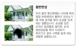 황반변성