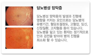 당뇨병성 망막증