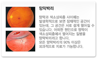망막박리