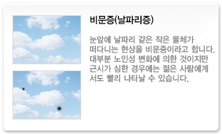비문증(날파리증)
