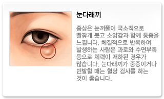눈다래끼
