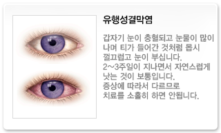 유행설결막염